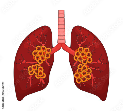 Human lungs affected by late-stage cancer 2D vector illustration. Malignant cells. Alveoli oncology. Tumor growths in branching bronchi flat object isolated on white background. Colorful cartoon image