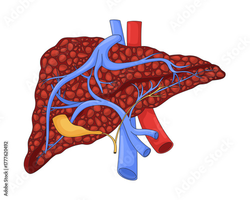 Human liver with cirrhosis and damaged nodular tissue 2D vector illustration. Hepatic disease. Internal organ tumor. Fibrosis pathology flat object isolated on white background. Colorful cartoon image