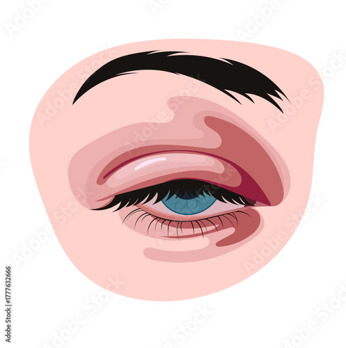 Swollen Eye from Bacterial Infection Illustration Isolated on White Background