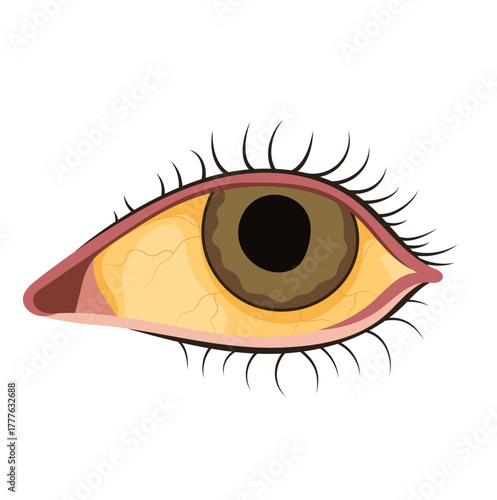 Jaundice Eye Symptom Illustration Isolated on White Background