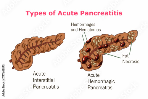 Types of Acute Pancreatitis, Hemorrhages and Hematomas, Fat Necrosis
