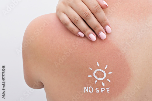 Wallpaper Mural Closeup of red sunburn on shoulder with NO SPF sun symbol in cream, tender skin and UV exposure shown Torontodigital.ca