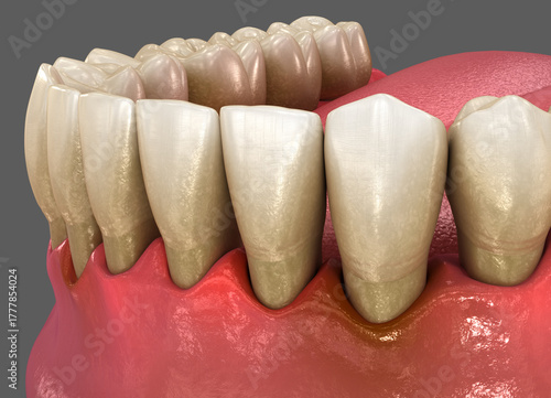 Gum recession, inflammation of the gums. Dental 3D illustration