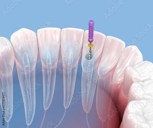 Endodontic root canal treatment process. Medically accurate tooth 3D illustration.