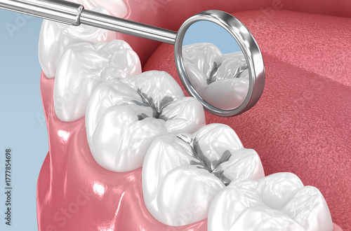 Amalgam tooth restoration. Dental 3D illustration