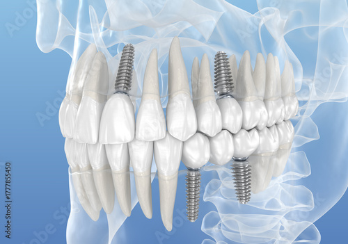 Teeth recovery with dental implant, transparent view. Medically accurate 3D illustration