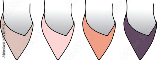 Medical illustration demonstrating the stages of gum disease, showing the progression of gingival color from healthy pink to inflamed purple