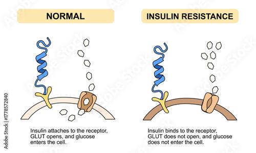 Medical illustration of insulin resistance, one of the causes of type 2 diabetes, unresponsive cells, diagram of healthy and diabetic cells, vector illustration for medical, poster and science