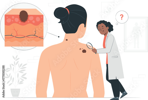 Doctor examining a patient's moles with a magnifying glass and skin diagram vector illustration