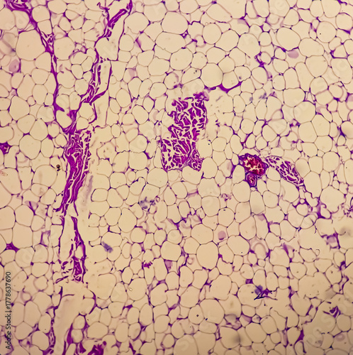 Lipoma, benign growth of fatty tissue, benign neoplasm, adipocytes, partially capsulated tumor, 40x microscopic view.
