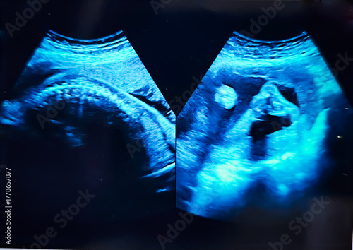 Foto Collage of medical images of ultrasound anomaly scan on a male fetus 25 weeks into the pregnancy, inside womb