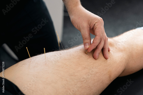 Physiotherapist doing dry needling therapy on male leg, acupuncture.