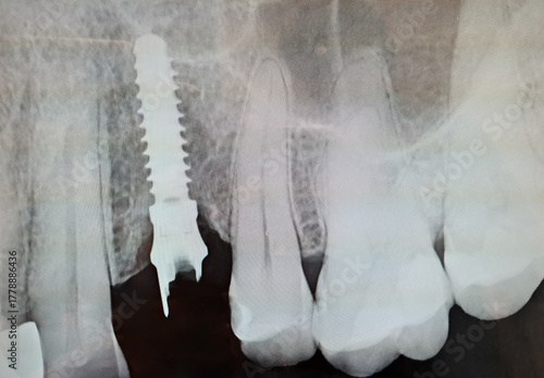Loss of a dental implant. X-ray of a dental implant in the jawbone and a broken implant abutment. X-ray of the jaw and teeth at the dentist. Dental concept.