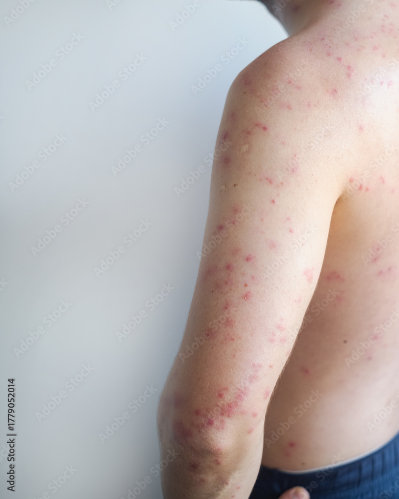 Naklejka premium Man with large blisters on torso and arms showing sudden onset of acute hives with redness and swelling.