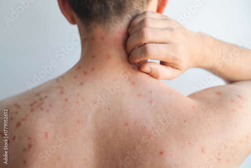 Obraz na plátně Man with red itchy rash and ring shaped inflamed spots on body showing signs of fungal skin infection in video
