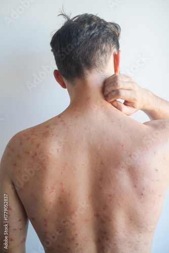 Man with itchy red rash over body from dry irritated skin experiencing discomfort and soothing inflamed areas.