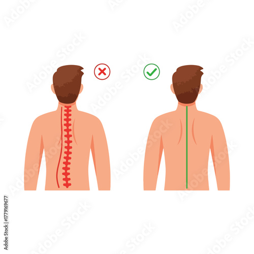 Bad and good posture illustration, human back with spine scoliosis and healthy straight spine