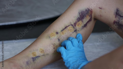 Doctor checking wounds some days after innovative method of varicose veins surgery, sclerotherapy procedure. Close-up shot of patient legs. 4K