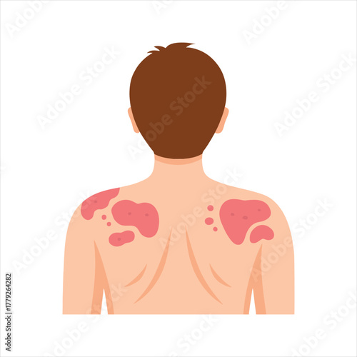 Person with back skin condition showing red rash and irritation isolated on white background