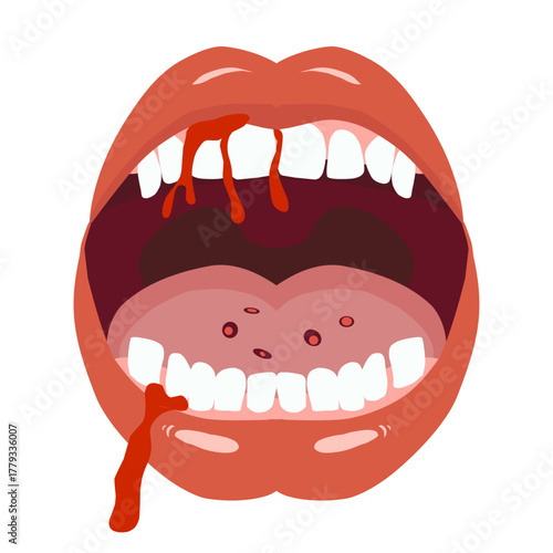 Open Mouth with Bleeding Gums and Oral Ulcer Vector