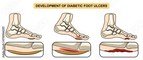 Development of diabetic foot ulcers. Superficial callus formation, pressure on the foot, inflammation and bleeding, ulcer expansion, deep ulcer. Vector illustration for medical, clinic and poster