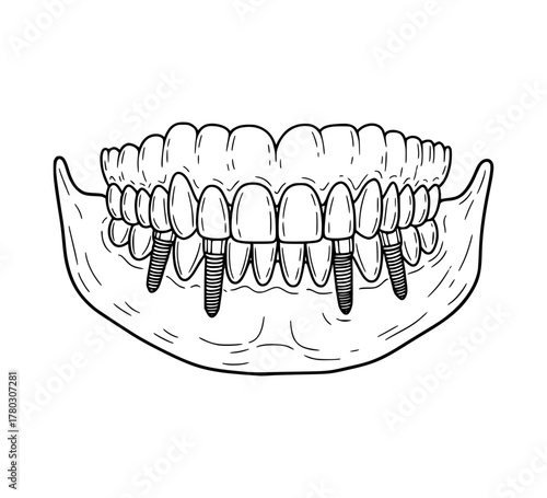 Tooth implant vector line art. Human teeth anatomy. 