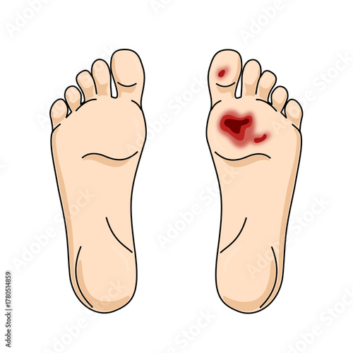 Illustration of healthy feet and diabetic feet, foot wounds, wide and deep ulcers, inflammation, pain and amputation. Vector illustration for medical, clinic and education.