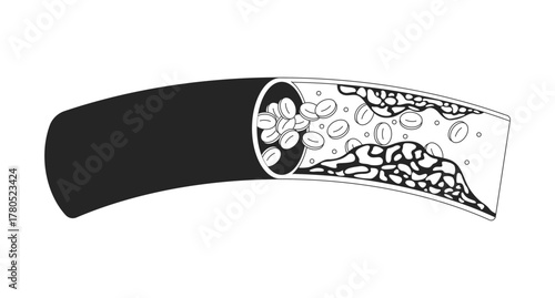 Cholesterol plaque obstructing blood flow outline illustration. Impeding red bloodcell circulation. Coronary artery disease 2D line object isolated on white. Monochrome vector ink linear image