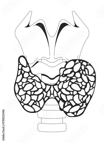 Enlarged thyroid gland affected by hyperthyroidism outline illustration. Hormone imbalance. Overactive disorder in neck anatomy 2D line object isolated on white. Monochrome vector ink linear image