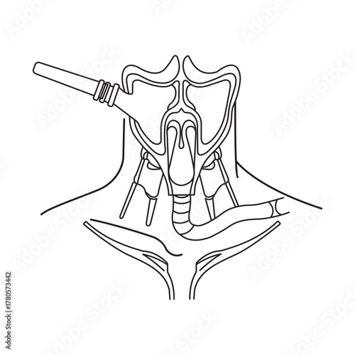 Laryngoscopy Procedure Illustration Medical Examination Throat Inspection Diagnosis Healthcare Anatomy Medicine Diagram