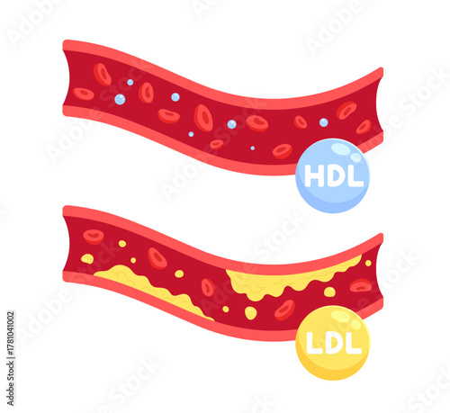 HDL and LDL cholesterol in blood vessels. High-Density Lipoprotein and Low-Density Lipoprotein. Healthy and unhealthy lifestyle. density of fat in the arterie. Flat vector illustration.