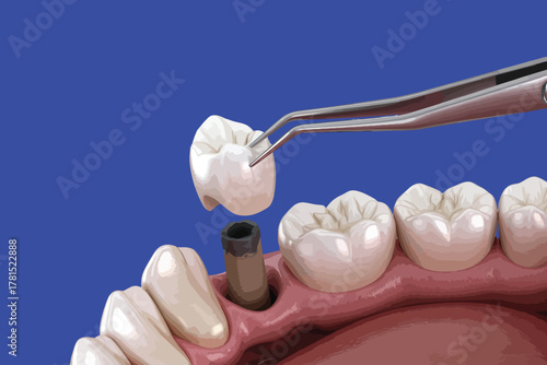 Close up of dental implant crown being precisely placed with forceps on a vibrant blue background