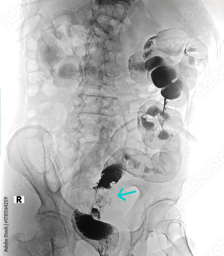 Xray imaging of colon carcinoma barium enema contrast study