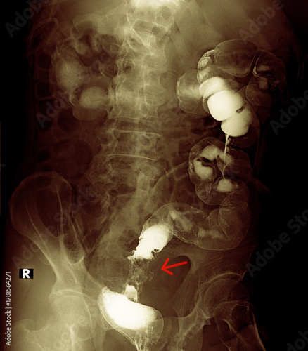 Xray imaging of colon carcinoma barium enema contrast study