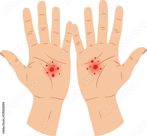 Flat medical illustration showing symmetrical palmar erythema with red spots on both palms, useful for educational, dermatology, or health awareness content