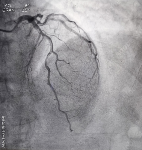 Coronary angiogram of left coronary artery during cardiac catheterization with contrast dye. Abnormal findings. Colour adjust