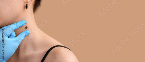 Dermatologist examining mol...