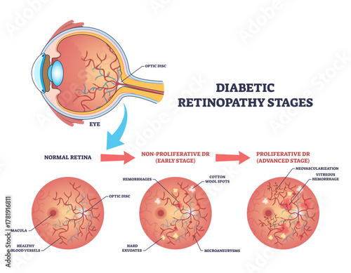 Diabetic retinopathy stages diagram shows retina, optic disc, and blood vessels, illustrating normal to non proliferative to proliferative progression for patient education, transparent background.