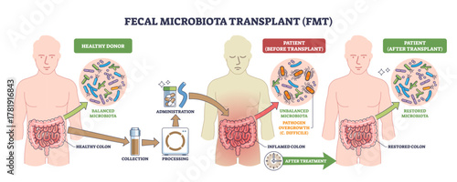 Fecal microbiota transplant (FMT) shown from donor to patient, stool processing and administration restore gut microbiota, key objects, intestines, capsules, bacteria, transparent background.