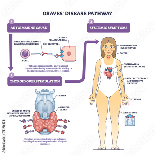 Graves disease pathway brief diagram explains autoimmune antibodies overstimulating the thyroid with a patient figure showing symptoms, thyroid, antibodies, woman, transparent background.