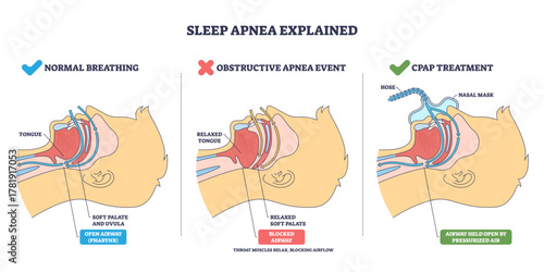 Normal breathing overview shows airflow, tongue and soft palate shape open vs blocked airway, transparent background.CPAP holds airway open.Key objects, airway, tongue, nasal mask.