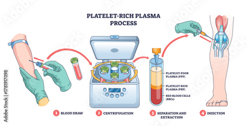 Platelet-rich plasma process shows blood draw, centrifuge separation, and PRP injection into the knee for healing, key objects, syringe, centrifuge, knee joint, transparent background.