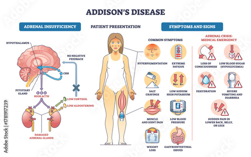 Addisons disease outline illustrates adrenal insufficiency, HPA axis, symptoms, and crisis alerts, key objects, adrenal glands, pituitary-brain, patient figure, transparent background.