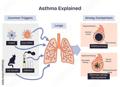Asthma explained in a brief sketch, lungs, common triggers, and airway comparison show how pollen, dust mites, and pollution tighten airways and add mucus during attacks, transparent background.