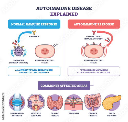 Autoimmune disease brief diagram contrasts normal and autoimmune response, highlighting antibody, autoantibody, and healthy cell, icons show affected organs, transparent background.