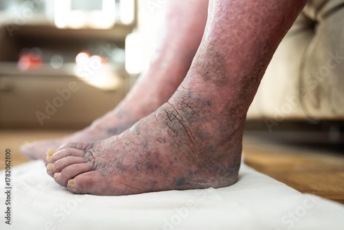 Billede på lærred This image captures a pair of swollen feet and ankles, illustrating the physical effects of edema amid the familiar comforts of a home environment and personal care