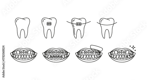 Minimalistic line icon set illustrating the process of orthodontic treatment, showing teeth before, during, and after wearing braces, alongside detailed views of dental arches with and without