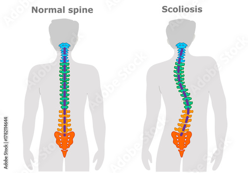  Scoliosis is a curvature of the spine. Vertebral column structure. Colored description. cervical spline, thoracic vertebrae, lumbar, pelvic, coccyx, spinal cord. Herniated disc. Vector illustration
