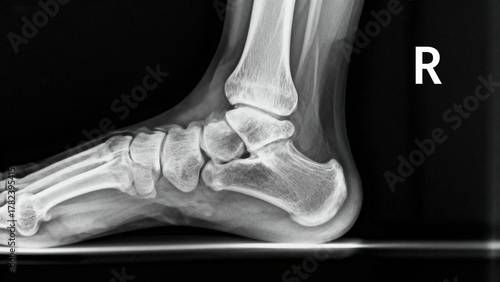 X ray of a human foot