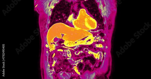 Colorful MRI upper abdomen showing vivid visualization of abdominal organs and vessels. Demonstrates advanced radiology imaging technology for precise medical diagnosis and research.